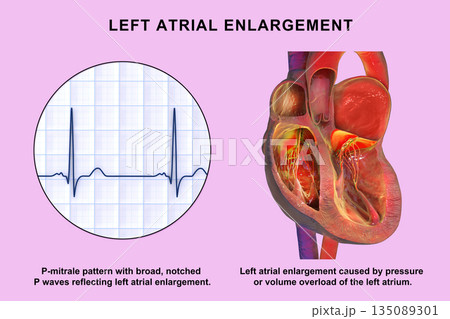 Left atrial dilation with P-mitrale, 3D illustration Left atrial dilation with P-mitrale, 3D illustration 135089301