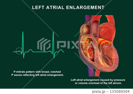 Left atrial dilation with P-mitrale, 3D...のイラスト素材 [135089304] - PIXTA