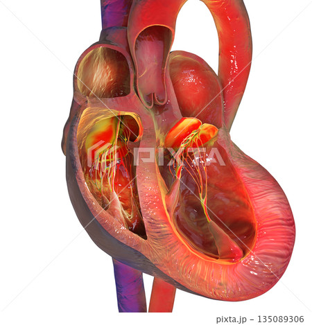 Eccentric left ventricular hypertrophy, 3D illustration 135089306