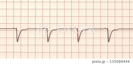 Left ventricular hypertrophy, 3D illustration Left ventricular hypertrophy, 3D illustration 135089444