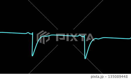 Left ventricular hypertrophy, 3D illustration Left ventricular hypertrophy, 3D illustration 135089448