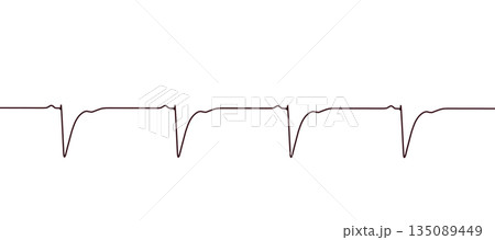 Left ventricular hypertrophy, 3D illustration Left ventricular hypertrophy, 3D illustration 135089449