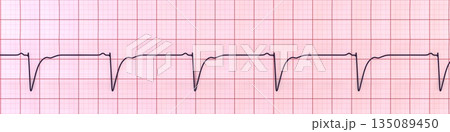 Left ventricular hypertrophy, 3D illustration 135089450