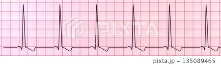 Left ventricular hypertrophy, 3D illustration 135089465
