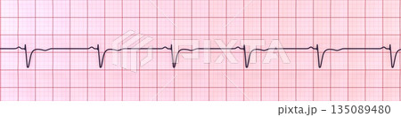 Normal ECG in V1-V2, 3D illustration 135089480