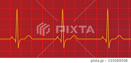 P-pulmonale, 3D illustration P-pulmonale, 3D illustration 135089506