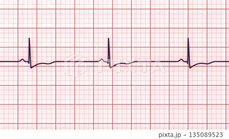 Right ventricular hypertrophy, 3D illustration Right ventricular hypertrophy, 3D illustration 135089523