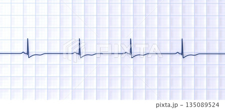 Right ventricular hypertrophy, 3D illustration Right ventricular hypertrophy, 3D illustration 135089524