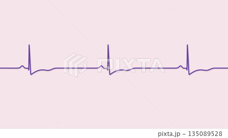 Right ventricular hypertrophy, 3D illustration Right ventricular hypertrophy, 3D illustration 135089528