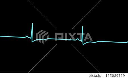 Right ventricular hypertrophy, 3D illustration Right ventricular hypertrophy, 3D illustration 135089529