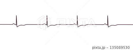 Right ventricular hypertrophy, 3D illustration Right ventricular hypertrophy, 3D illustration 135089530