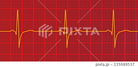 Right ventricular hypertrophy, 3D illustration Right ventricular hypertrophy, 3D illustration 135089537