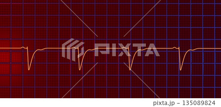 Left ventricular hypertrophy, 3D illustration 135089824