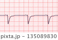 Left ventricular hypertrophy, 3D illustration 135089830