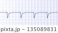Left ventricular hypertrophy, 3D illustration 135089831