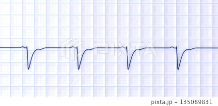 Left ventricular hypertrophy, 3D illustration Left ventricular hypertrophy, 3D illustration 135089831