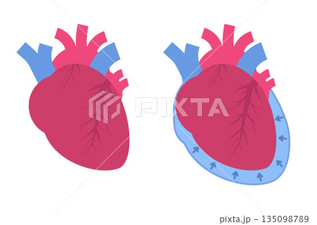 Pericardial effusion concept. Cardiovascular system medical vector illustration. 135098789