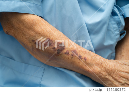 Ecchymosis, elderly bleeding on her arm after taking aspirin. 135100372