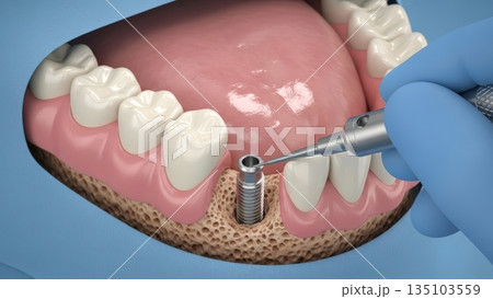 インプラント治療の工程を示す口腔内断面図のイメージ画像 135103559