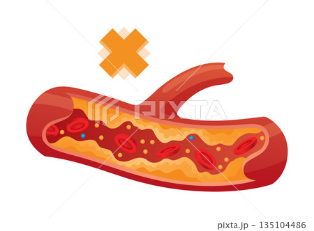 Type of cholesterol in human blood vessels. Narrowed artery for explanation diseases. Low-Density Lipoprotein LDL . Vector illustration 135104486