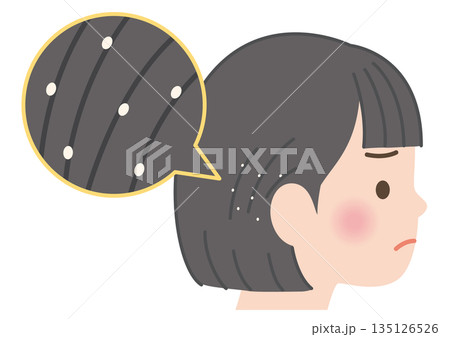 髪にアタマジラミの卵が付着している子供 135126526