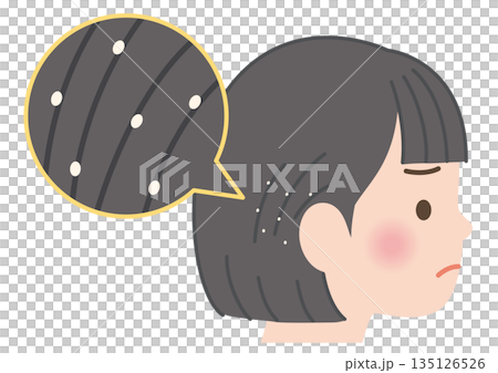 髪にアタマジラミの卵が付着している子供 135126526