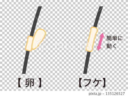 How to distinguish between head lice eggs and dandruff 135126527