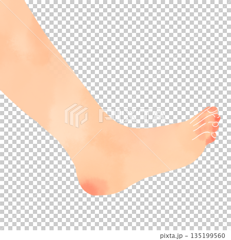 Watercolor illustration of feet, chilblains and cold symptoms image material 135199560