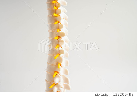 Spinal nerve and bone, Lumbar spine displaced herniated disc fragment, Model for treatment medical in the orthopedic department. Spinal nerve and bone, Lumbar spine displaced herniated disc fragment, Model for treatment medical in the orthopedic department. 135209495