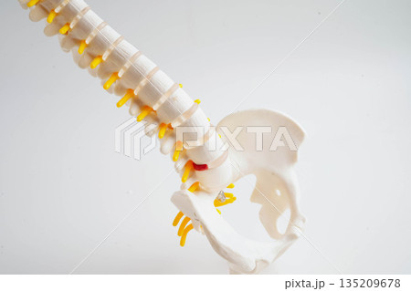 Spinal nerve and bone, Lumbar spine displaced herniated disc fragment, Model for treatment medical in the orthopedic department. Spinal nerve and bone, Lumbar spine displaced herniated disc fragment, Model for treatment medical in the orthopedic department. 135209678