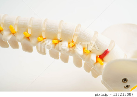 Spinal nerve and bone, Lumbar spine displaced herniated disc fragment, Model for treatment medical in the orthopedic department. 135213097