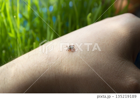 Infected dangerous tick on human skin - a carrier of infections and viruses Infected dangerous tick on human skin - a carrier of infections and viruses 135219189