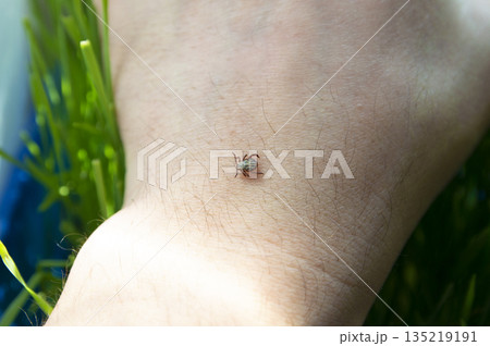 Infected dangerous biting tick on human skin. Infected dangerous biting tick on human skin. 135219191