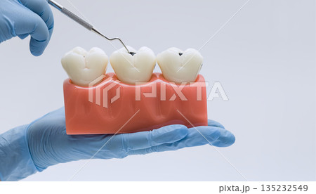 Dental explorer pointing at tooth decay on molar model Dental explorer pointing at tooth decay on molar model 135232549