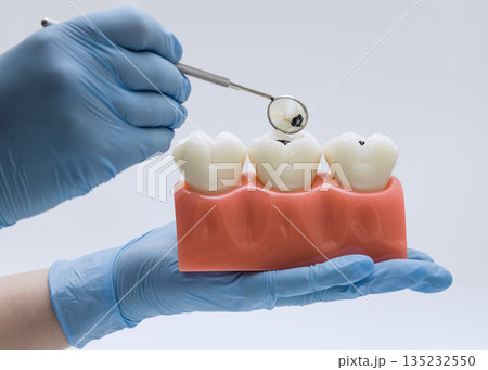 Gloved hands use a dental mirror to inspect visible cavities on a three-molar educational model for oral health training. 135232550
