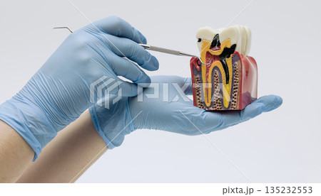 Gloved hands holding a detailed tooth cross section model, illustrating cavity development and internal tooth structure for dental education and healthcare training. Gloved hands holding a detailed tooth cross section model, illustrating cavity development and internal tooth structure for dental education and healthcare training. 135232553