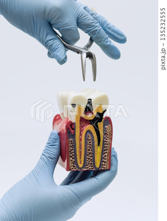 Dental extraction demonstration with decayed tooth model 135232555