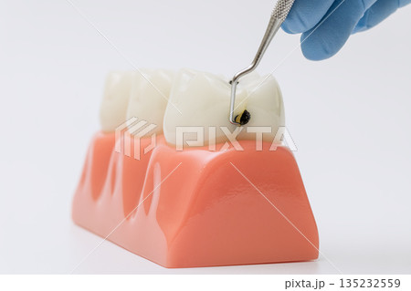 Dental model showing tooth decay and cavity examination Dental model showing tooth decay and cavity examination 135232559