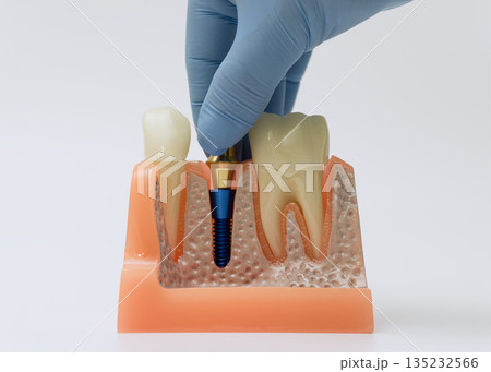 Dental implant integration model held by gloved hand Dental implant integration model held by gloved hand 135232566