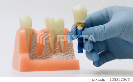 Gloved hand holding dental implant next to jaw model Gloved hand holding dental implant next to jaw model 135232567