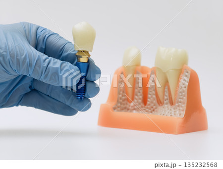 Gloved hand holding dental implant near jaw model 135232568