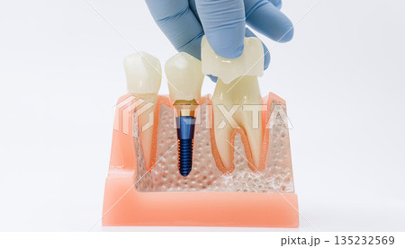 Gloved hand aligning crown over dental implant model 135232569