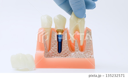 Hand holding extracted tooth above dental implant model Hand holding extracted tooth above dental implant model 135232571