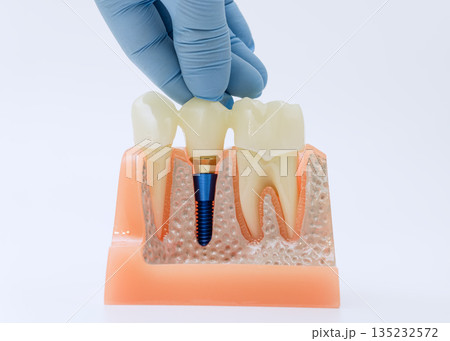 Placing crown on dental implant in gum model 135232572