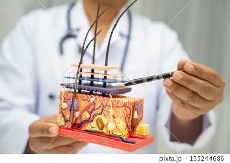 Hair transplant, Asian dermatologist doctor holding skin structure anatomy model for treatment in hospital. 135244686