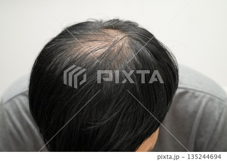 Bald head in man, hair loss treatment health problem. Bald head in man, hair loss treatment health problem. 135244694