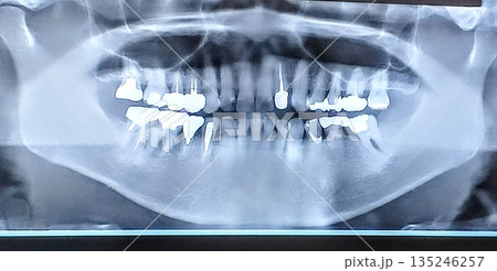 歯医者のレントゲン写真 135246257