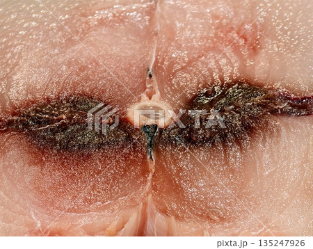Clinical view of irritated naval area with infection signs Clinical view of irritated naval area with infection signs 135247926