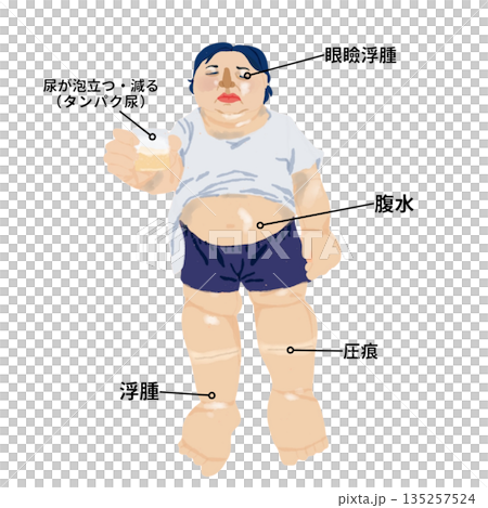 腎病症候群症狀示意圖 | 患者表現為全身水腫、眼瞼水腫、腹水及蛋白尿 腎病症候群症狀示意圖 | 患者表現為全身水腫、眼瞼水腫、腹水及蛋白尿 135257524