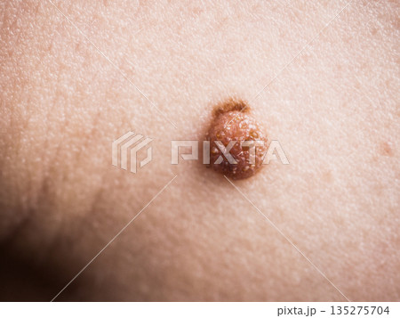 Skin with dark fibroma. Close up of papilloma dermatosis 135275704